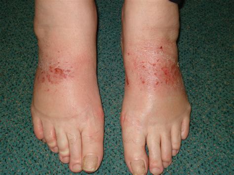 Dermatitis Feet Pictures Photos