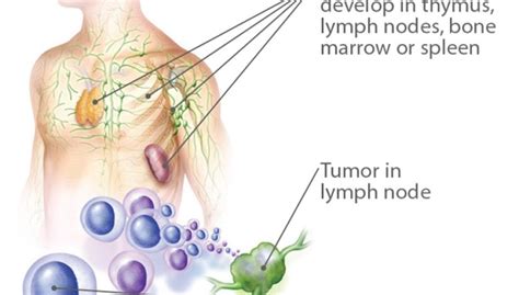 Lymphoma Cancer That Challenges Your Immune System Positive Bioscience