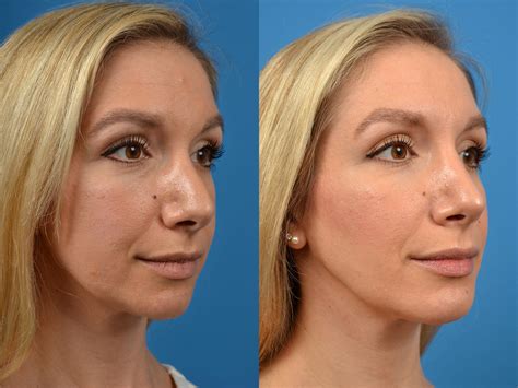 Rhinoplasty Photos Melbourne Fl Patient 56566