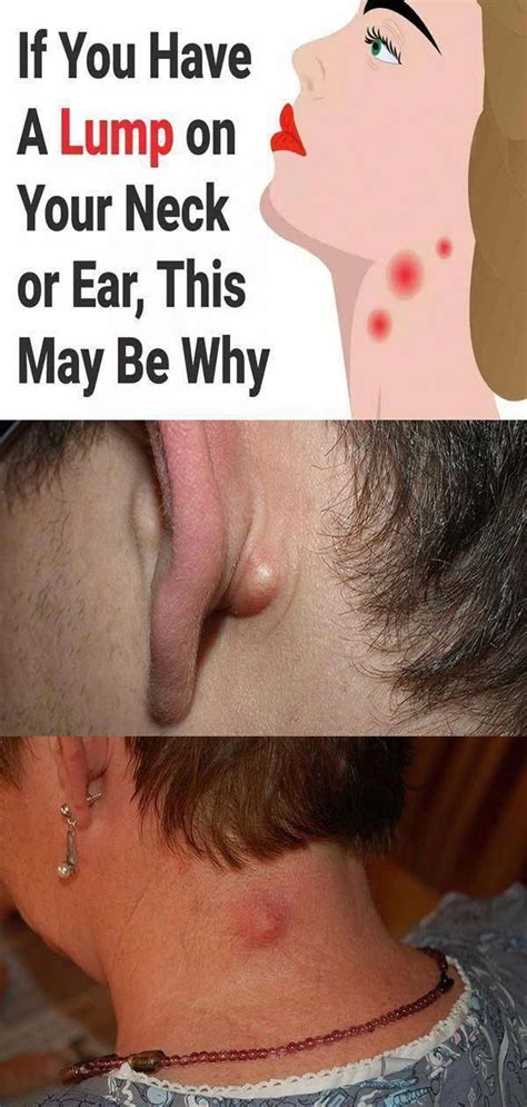 Do You May Have A Lump On Your Neck Back Or Behind Your Ear This Is