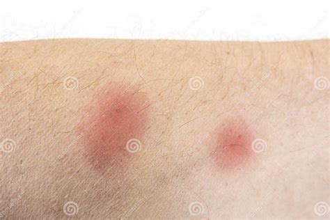 Bites Of Insect On Male Body Bed Bugs Or Flea Stock Image Image Of