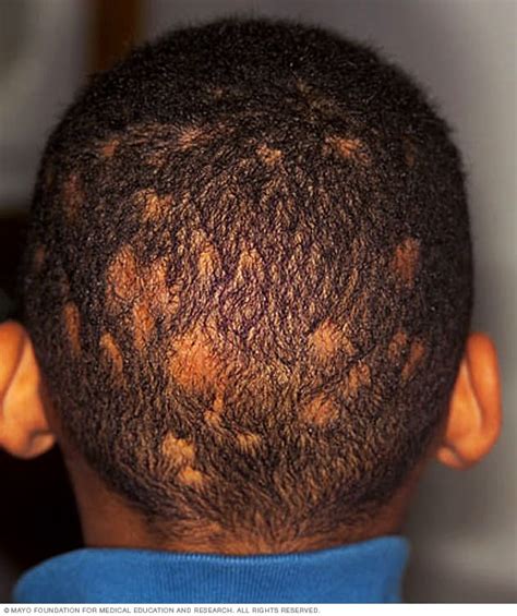 Ringworm Of The Scalp Mayo Clinic
