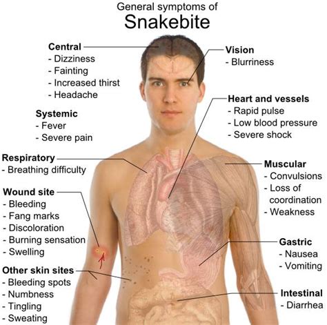 Snakebite Symptoms Ke