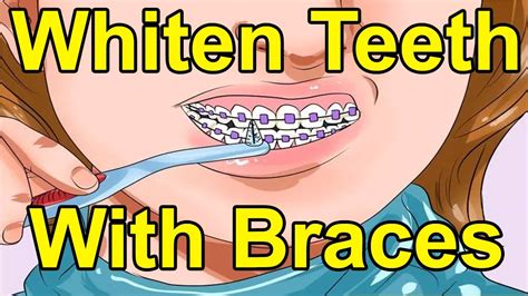 How To Whiten Teeth With Braces Diy 5 Diy Remedies To Whiten Your Teeth At Home Diy Home