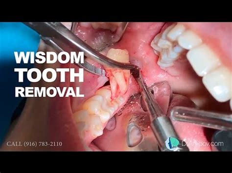 Wisdom Tooth Removal In Min Or Less Dental Clinic