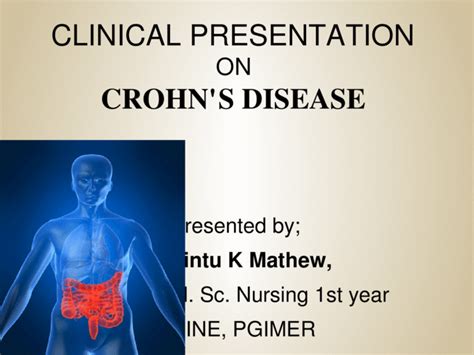 Crohns Disease Ppt