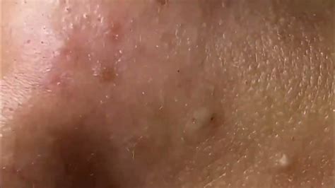 Pimple Popping Removing Blackheads Around Eyes And Mouth Bigger