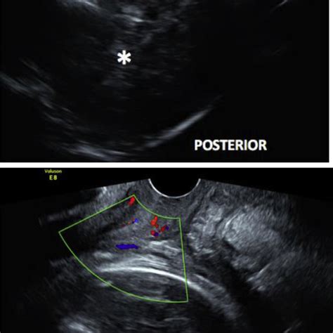 Transvaginal Ultrasound Image 1 The White Curve An Elongated Cervix