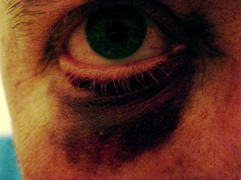 Black Eye 5 Pirates Eye 30 Hours On Dion Gillard Flickr