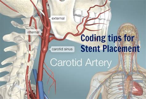 Cervical artery dissection is a dissection of any of the arteries in the neck. Secret tips Carotid Artery &Innominate Artery Stent ...