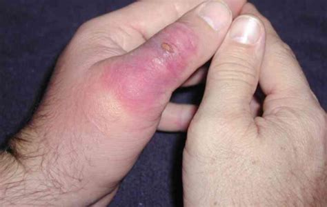 What Are The Symptoms Of A Brown Recluse Spider Bite
