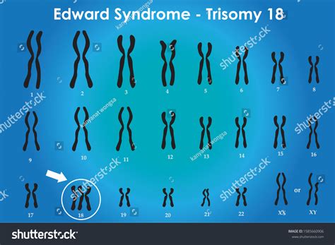 Edward Syndrome Karyotype One Chromosomal Disorders