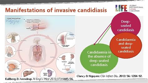 Invasive Candidiasis Part 1 Aetiology Pathogenesis Clinical Manifestation