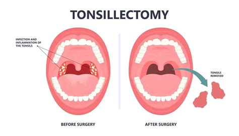 Tonsillectomy For Sleep Apnea Surgery And Recovery Process Zyppah