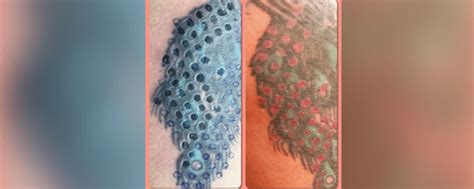 Hours may change under current circumstances Laser Tattoo Removal Timeline | wallpaper tattoo