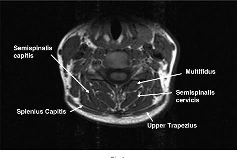 Cervical Mri Anatomy