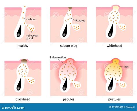 Acne Formation Process Skin Layer Types Of Acne Healthy Skin Sebum Plug Whitehead Blackhead