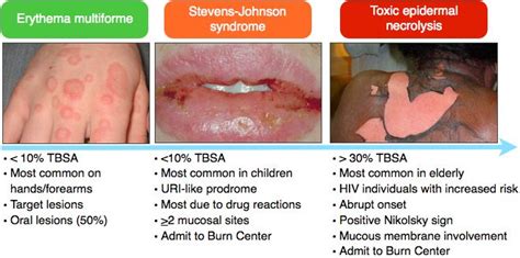 Rosh Review Steven Johnson Syndrome Dermatology Nurse Practitioner