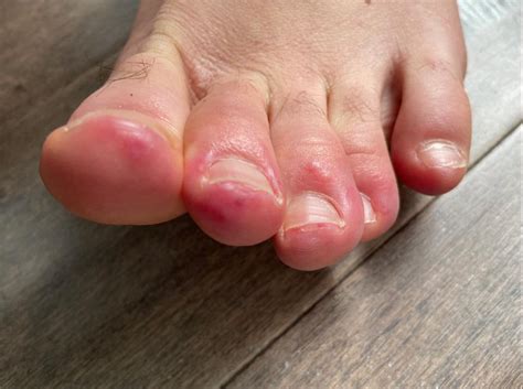 Spots On Toes And Rashes Join Weird New Symptoms Of Coronavirus Virus