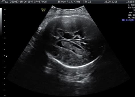 Sonographic Finding Of Ventriculomegaly With Late Onset 37 Weeks Of