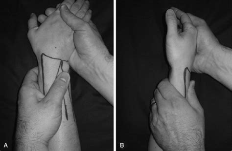 Ulnar Impaction Syndrome Musculoskeletal Key