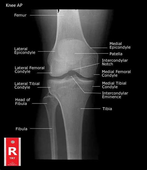 Knee Muscle Anatomy Mri A Snapshot Of The Diagnosis Of An Mri Of The