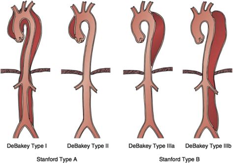 Type B Aortic Dissections Cardiology Clinics