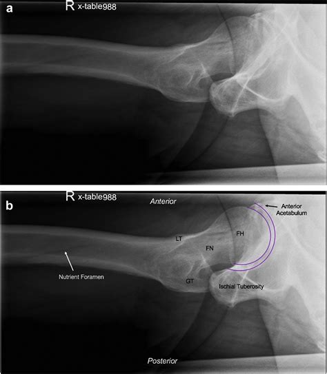 The Value Of The Direct Lateral Hip Radiograph In An Adult