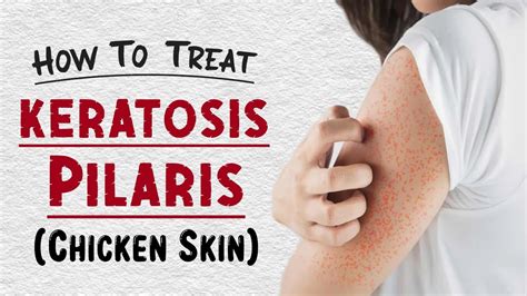 How To Treat Keratosis Pilaris At Home Chicken Skin Treatment Youtube