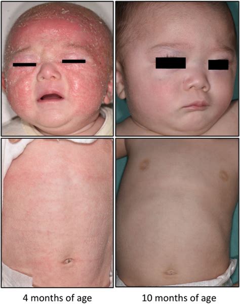 Transient Hypogammaglobulinemia Of Infancy With No Evidence Of