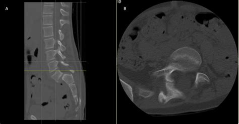 Cureus Scoliosis Associated With Lumbar Spondylolisthesis