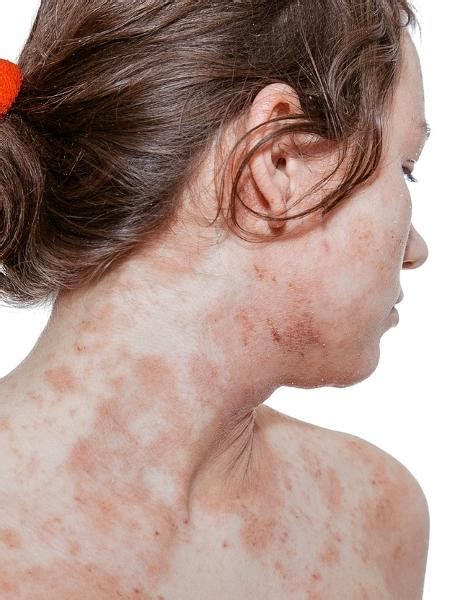 Dermatite At Pica Coceira Sem Fim Ataca Pele E Emocional Das Pessoas
