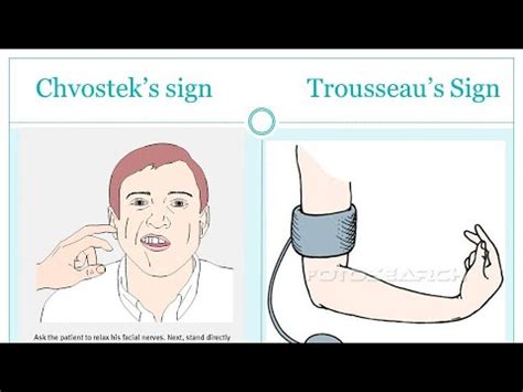 Trousseau S Sign Of Latent Tetany YouTube