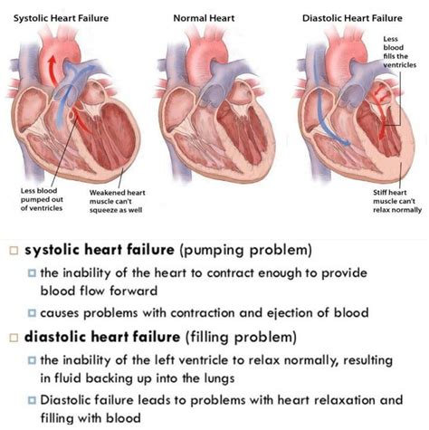Systolic Vs Diastolic Heart Failure Diastolic Heart Failure Heart