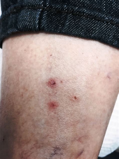 Diagnosing And Treating Distinctive Pink Papules On The Ankle