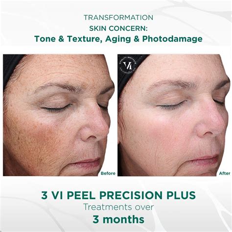 Vi Peel Treatment And Services In Nyc Manhattan