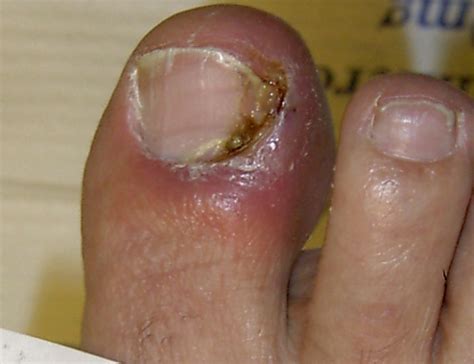An ingrown toenail occurs when the edge of the toenail, usually the big toe, grows into the skin next to it (called the lateral nail fold). Nail disease