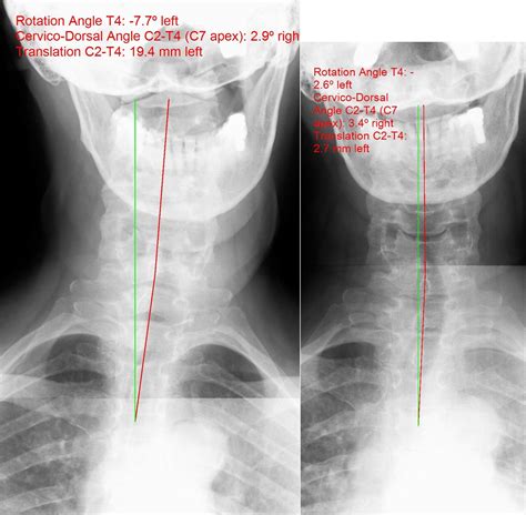 Pin On X Rays Showing Results Of Chiropractic And Physical Therapy Care