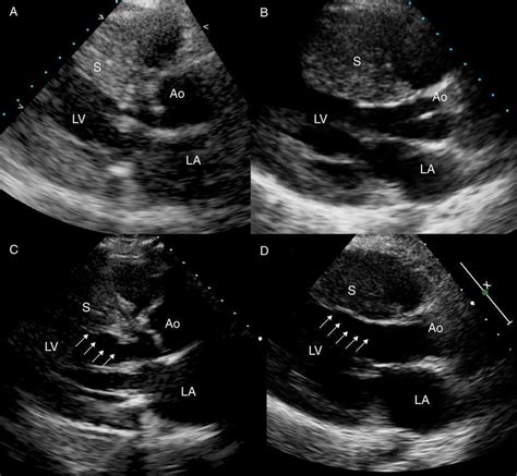 Alcohol Septal Ablation In Hypertrophic Cardiomyopathy An Opportunity