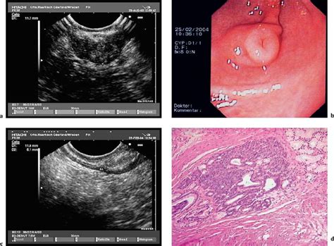 Endoscopic Ultrasound In Subepithelial Tumors Of The Gastrointestinal