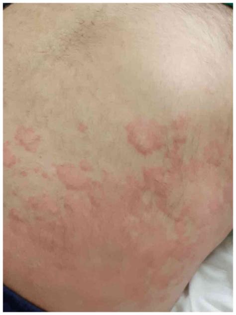 Mucocutaneous Lesions Associated With Sars‑cov‑2 Infection Review