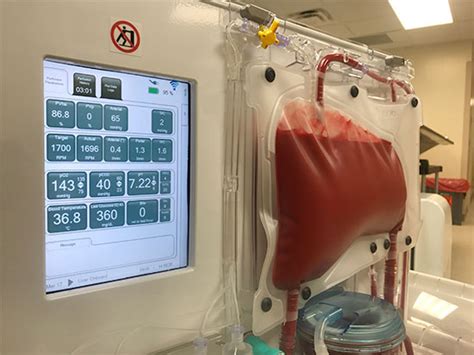 Surgeons Perform Alabamas First Liver Transplant Using A New Method