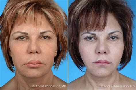 Facelift Incisions Which One Is Right For You Pasadena Ca