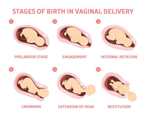 Vaginal Delivery Steps