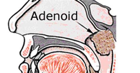 Case Study 6 Adenoids Enlarged Homoeomedic