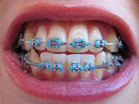 Pin By J T On Braces Orthodontics Braces Braces Orthodontics