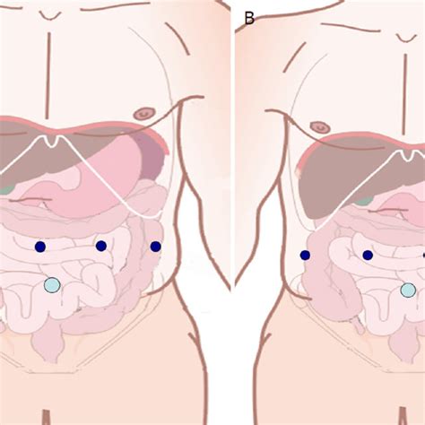 A Trocar Placement For Robotic Distal Pancreatectomy B Trocar Download Scientific Diagram