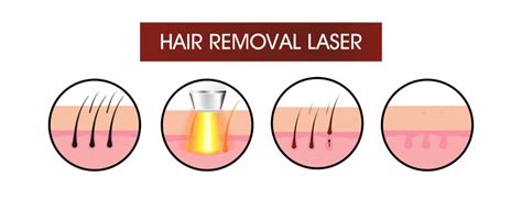 Laser Hair Removal FAQs Know Before Going For Laser Hair Treatment
