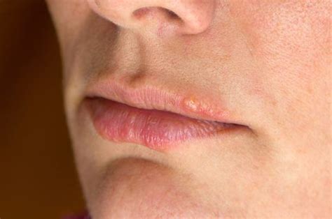 6 Blisters At The Corners Of The Mouth Health Wellness Fitness