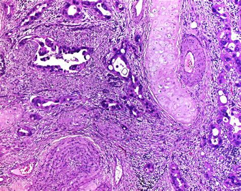 Acinar Adenocarcinoma At The Top And Right Well Formed Acinar